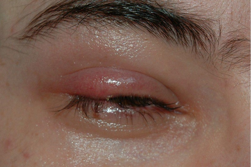 8 сигналов, при помощи которых глаза предупреждают о проблемах со здоровьем! Обрати внимание!