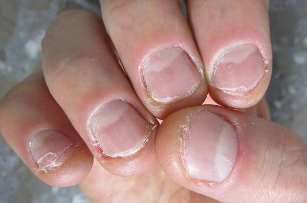 Почему нельзя грызть ногти: 9 последствий вредной привычки.