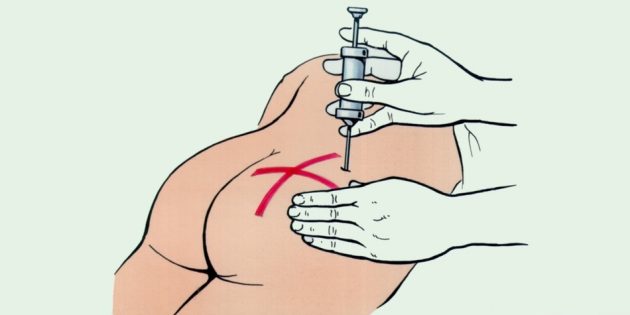 Как делать укол в ягодицу: очень подробная инструкция
