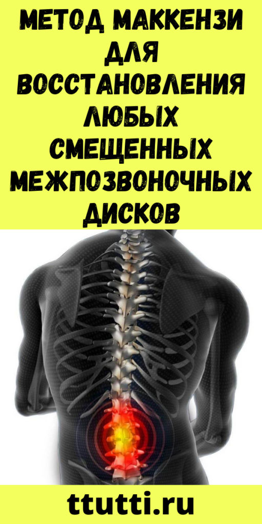 Метод Маккензи для восстановления любых смещенных межпозвоночных дисков