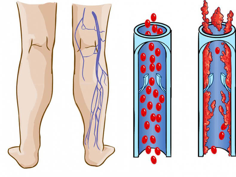 Варикоз глубоких вен нижних конечностей