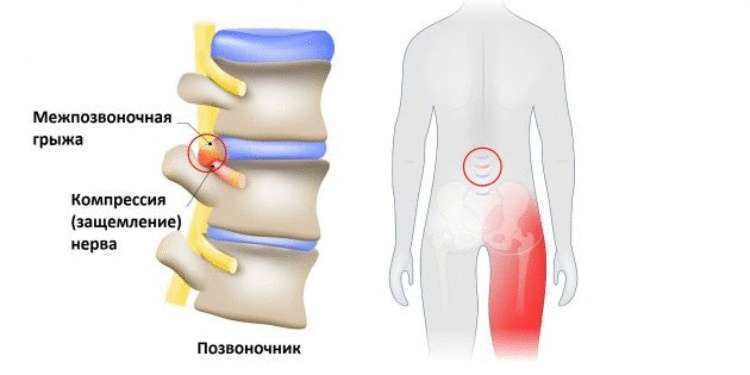 Как распознать защемление седалищного нерва и что с этим делать
