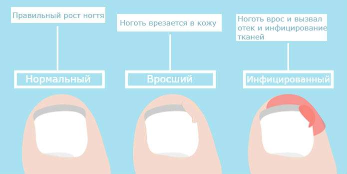 Вросший ноготь! Вот как от него избавиться без хирургии!