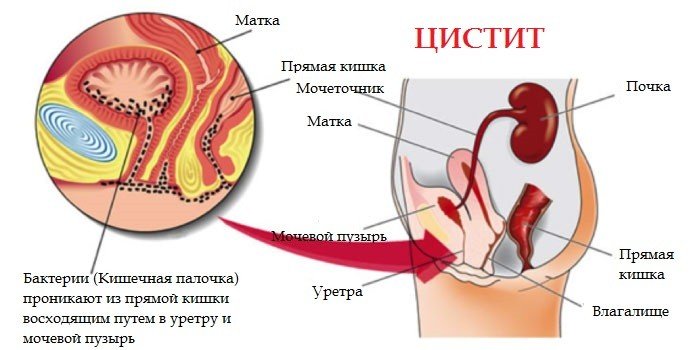 Лечение цистита у женщин: какие таблетки и травы помогут