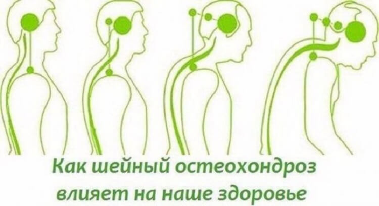 Как уберечься от остеохондроза и как та болезнь влияет на наше состояние Как уберечься от остеохондроза и как та болезнь влияет на наше состояние