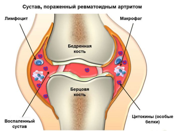 Артрит и артроз: в чем разница?