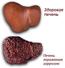 Застой желчи: профилактика и лечение