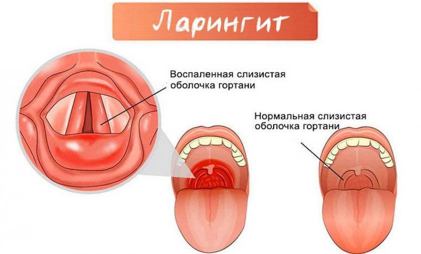 Ларингит и его основные симптомы о которых стоит знать