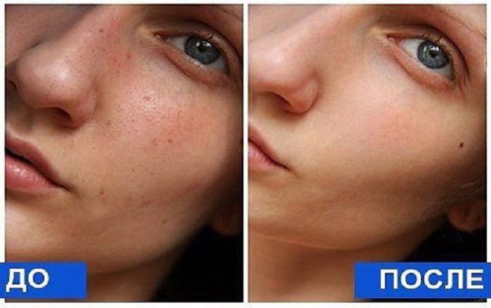 Как сделать глубокую чистку лица за одну процедуру. Рекомендуют даже косметологи