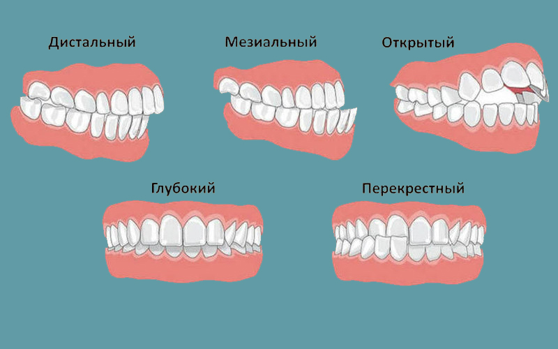 Важно знать! Связь прикуса и проблем с опорно-двигательным аппаратом Важно знать! Связь прикуса и проблем с опорно-двигательным аппаратом