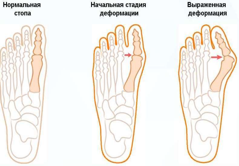 Вальгусная деформация стопы: упражнения и рекомендации ортопедов