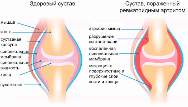 Что вредно для колен