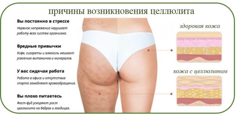 Волшебное средство, которое плавит целлюлит