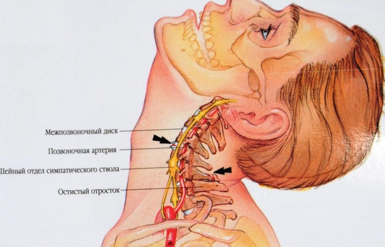 Как самому избавиться от отложений солей в шейном отделе
