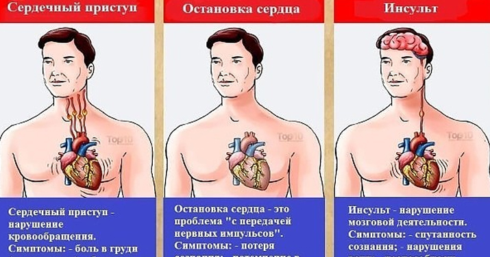Это может спасти вам жизнь: разница между инфарктом, инсультом и остановкой сердца