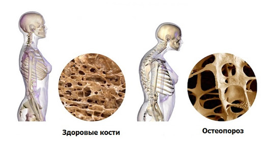 Связь остеопороза и микрофлоры кишечника: секрет, как сохранить активность в любом возрасте Связь остеопороза и микрофлоры кишечника: секрет, как сохранить активность в любом возрасте