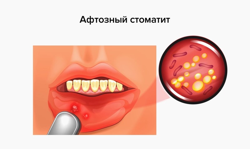 Белые язвочки во рту: причины и лечение