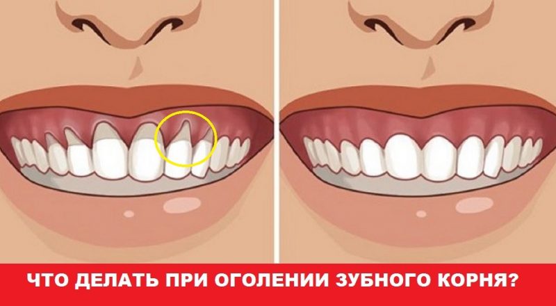 Оголилась шейка зуба? узнай, как вернуть десну обратно!
