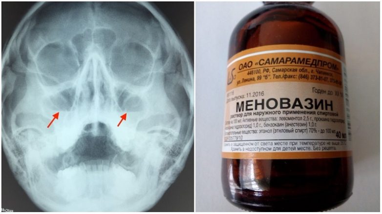Необычные способы применения «Меновазина»