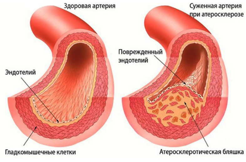Этот травяной сбор атеросклерозу не оставляет шансов — возьмите на заметку мое лечение, настоящее спасение!