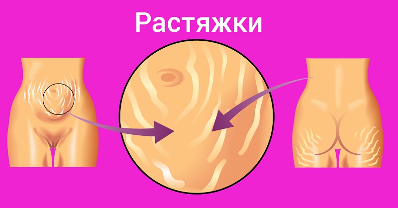 Куда делись растяжки? Копеечное средство из аптеки сделало кожу божественной